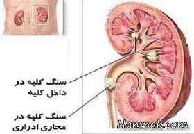 سنگ کلیه و روشهای درمان